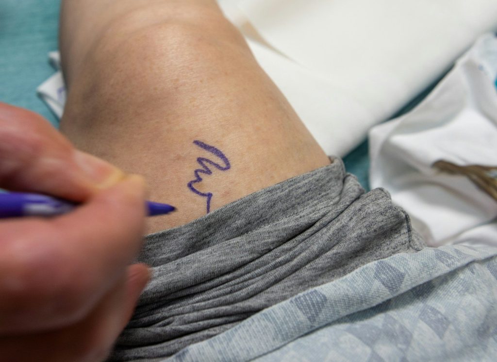 Knee Replacement A person is writing on a patient's arm.
